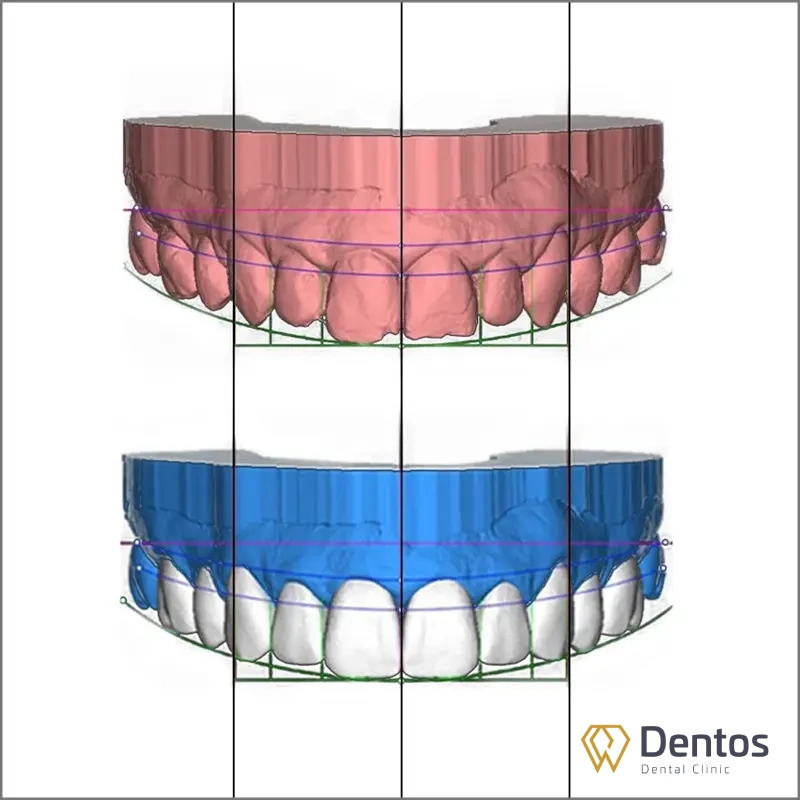 Quy trình làm răng sứ: thiết kế nụ cười cá nhân hóa với DSD